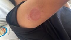 Avene Cicalfate+ Krem – CGM Sensör Kullanıcıları için Cilt Onarıcı Bakım Kremi