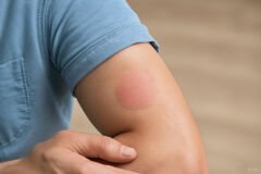 Avene Cicalfate+ Krem – CGM Sensör Kullanıcıları için Cilt Onarıcı Bakım Kremi