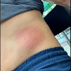 Avene Cicalfate+ Krem – CGM Sensör Kullanıcıları için Cilt Onarıcı Bakım Kremi