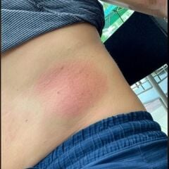 Avene Cicalfate+ Krem – CGM Sensör Kullanıcıları için Cilt Onarıcı Bakım Kremi